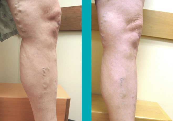 VenaSeal Treatment for Varicose Veins: Patient Before After Photo