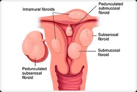 Fibroids- Description
